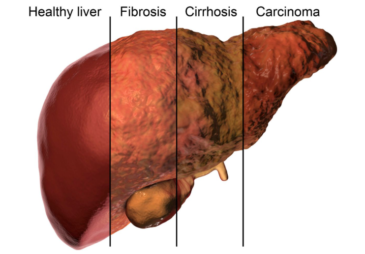 Liver Diseases