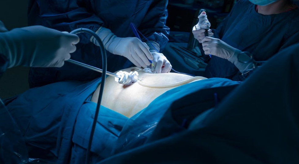 Hernia Repair